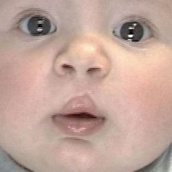 Cleft Lip Before & After Patient #1110