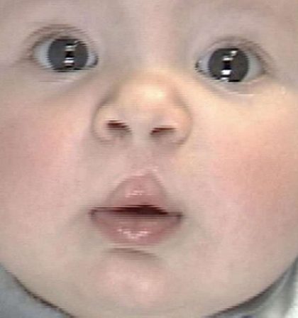 Cleft Lip Before & After Patient #1110