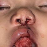 Cleft Lip Before & After Patient #1113