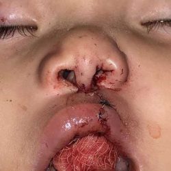 Cleft Lip Before & After Patient #1113