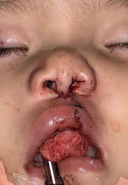 Cleft Lip Before & After Patient #1113