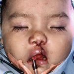 Cleft Lip Before & After Patient #1116