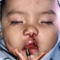 Cleft Lip Before & After Patient #1116