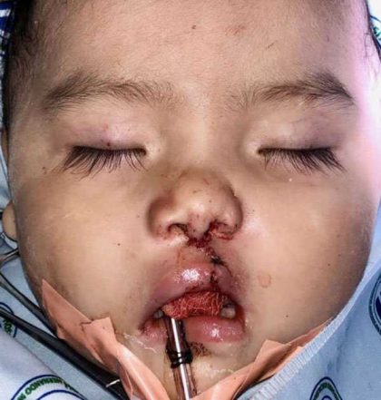 Cleft Lip Before & After Patient #1116