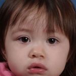 Cleft Lip Before & After Patient #1119