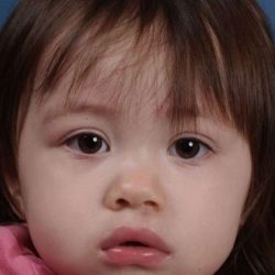 Cleft Lip Before & After Patient #1119
