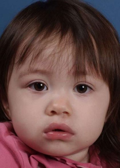 Cleft Lip Before & After Patient #1119