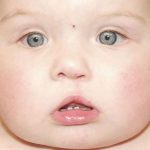 Cleft Lip Before & After Patient #1122