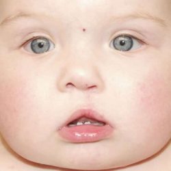 Cleft Lip Before & After Patient #1122