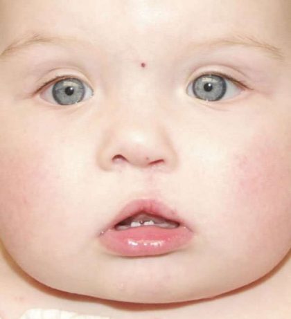 Cleft Lip Before & After Patient #1122
