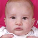 Cleft Lip Before & After Patient #1125