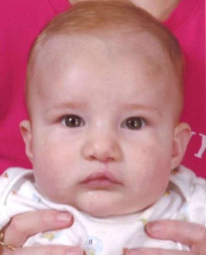 Cleft Lip Before & After Patient #1125