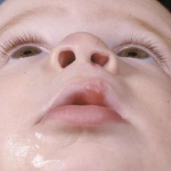 Cleft Lip Before & After Patient #1128