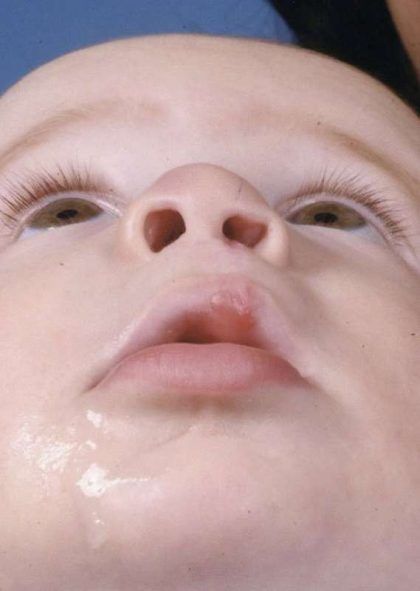 Cleft Lip Before & After Patient #1128