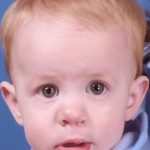 Cleft Lip Before & After Patient #1131