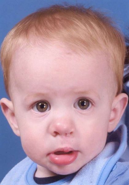 Cleft Lip Before & After Patient #1131