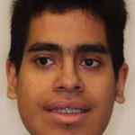 Jaw Surgery Before & After Patient #1137