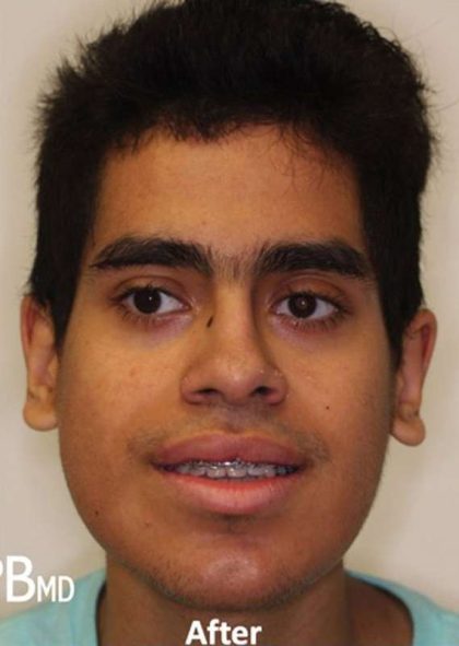 Jaw Surgery Before & After Patient #1137