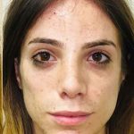 Facial Feminization Before & After Patient #900