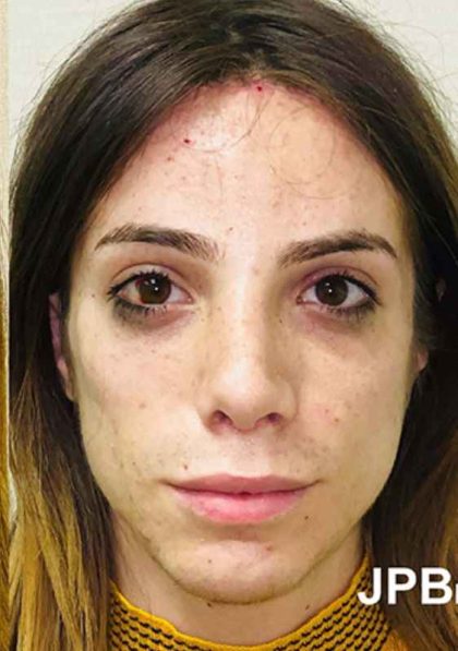 Facial Feminization Before & After Patient #900