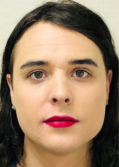 Facial Feminization Before & After Patient #876