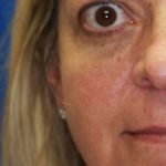 Craniofacial Before & After Patient #1176