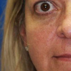 Craniofacial Before & After Patient #1176