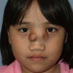 Craniofacial Before & After Patient #1182