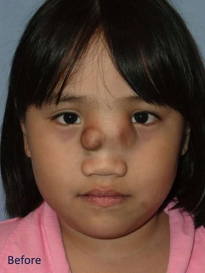 Craniofacial Before & After Patient #1182
