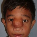 Craniofacial Before & After Patient #1191