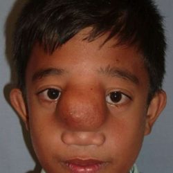 Craniofacial Before & After Patient #1191