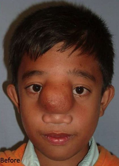 Craniofacial Before & After Patient #1191