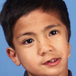 Craniofacial Before & After Patient #1194