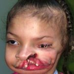 Craniofacial Before & After Patient #1197