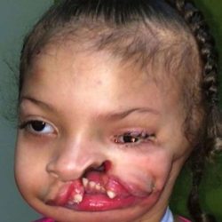Craniofacial Before & After Patient #1197