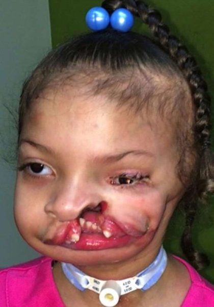 Craniofacial Before & After Patient #1197