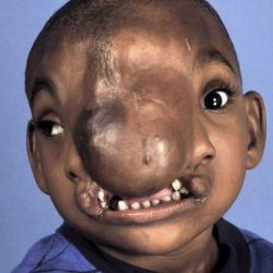 Craniofacial Before & After Patient #1200
