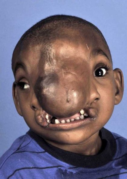 Craniofacial Before & After Patient #1200