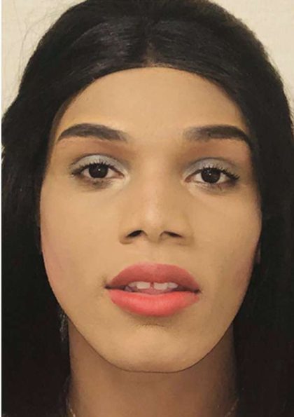 Facial Feminization Before & After Patient #906