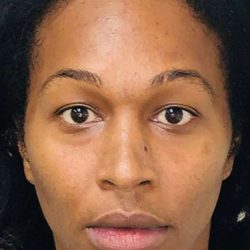 Facial Feminization Before & After Patient #912