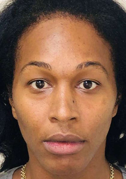 Facial Feminization Before & After Patient #912