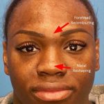Facial Feminization Before & After Patient #918
