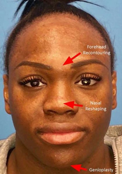 Facial Feminization Before & After Patient #918