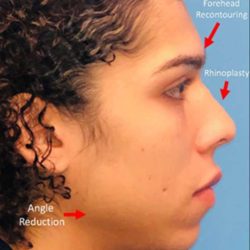 Facial Feminization Before & After Patient #924