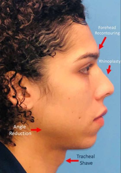 Facial Feminization Before & After Patient #924