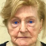 Facelift Before & After Patient #930