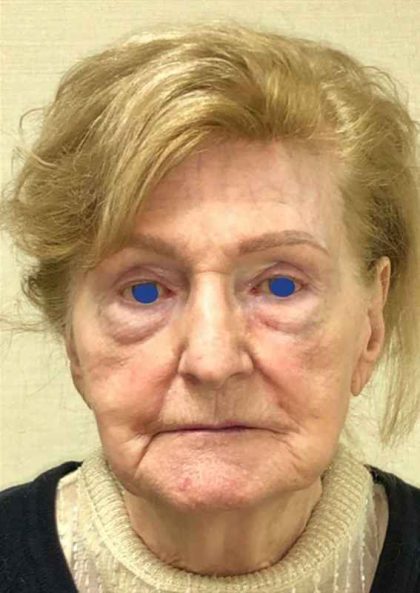Facelift Before & After Patient #930
