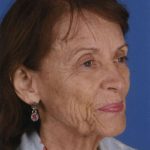 Facelift Before & After Patient #933