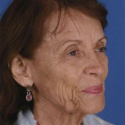 Facelift Before & After Patient #933