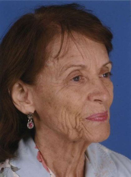 Facelift Before & After Patient #933